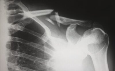 Hitting the Reset Button No. 3: Drop Your Elbows