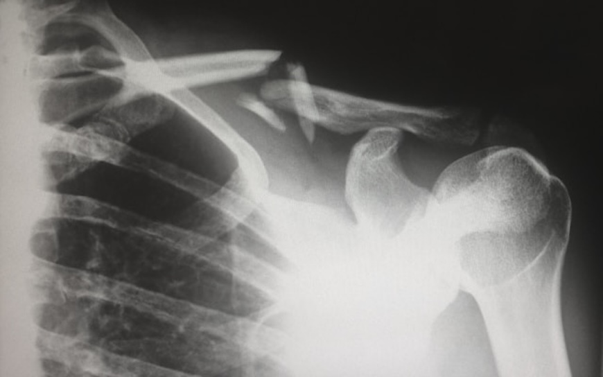 Hitting the Reset Button No. 3: Drop Your Elbows